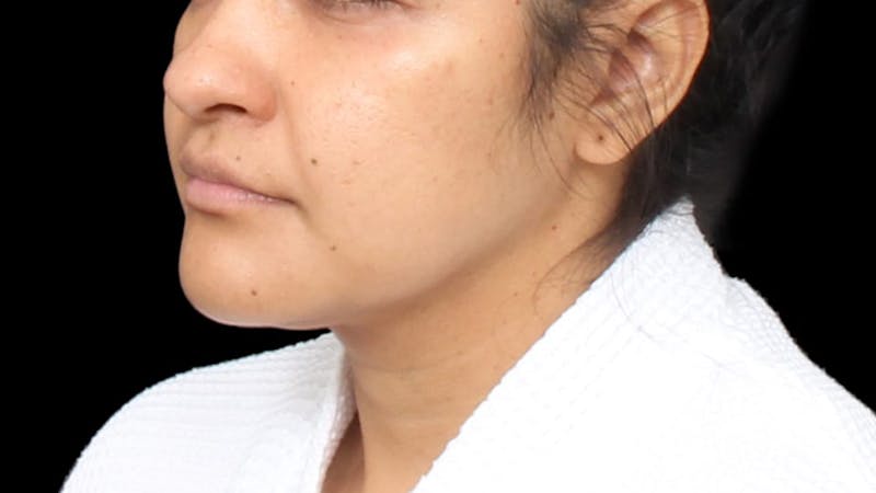 Chin Liposuction Before & After Gallery - Patient 313835 - Image 3