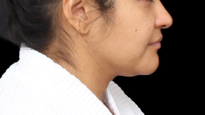 Chin Liposuction Before & After Gallery - Patient 313835 - Image 5