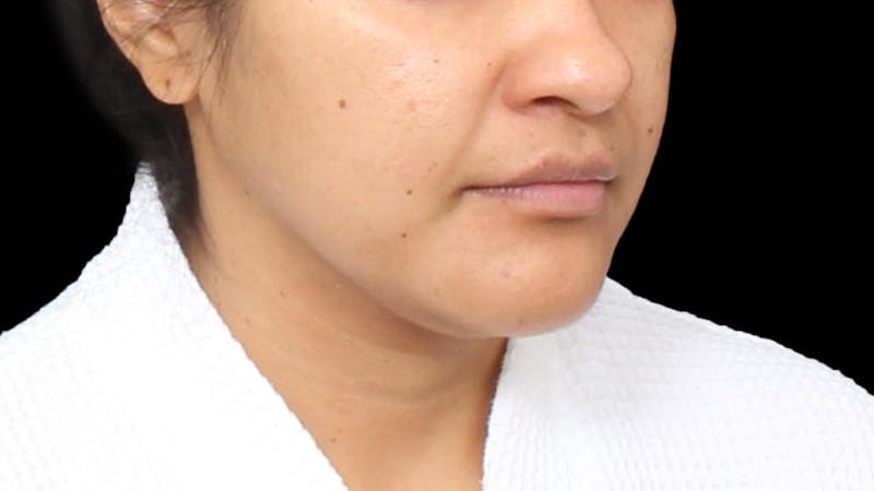 Chin Liposuction Before & After Gallery - Patient 313835 - Image 7