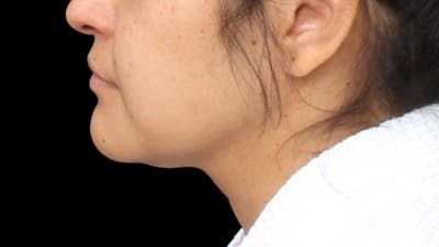 Chin Liposuction Before & After Gallery - Patient 313835 - Image 1