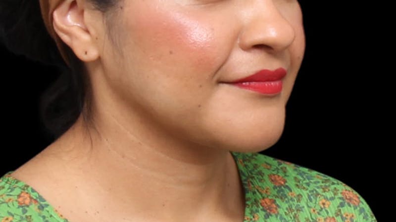 Chin Liposuction Before & After Gallery - Patient 313835 - Image 8