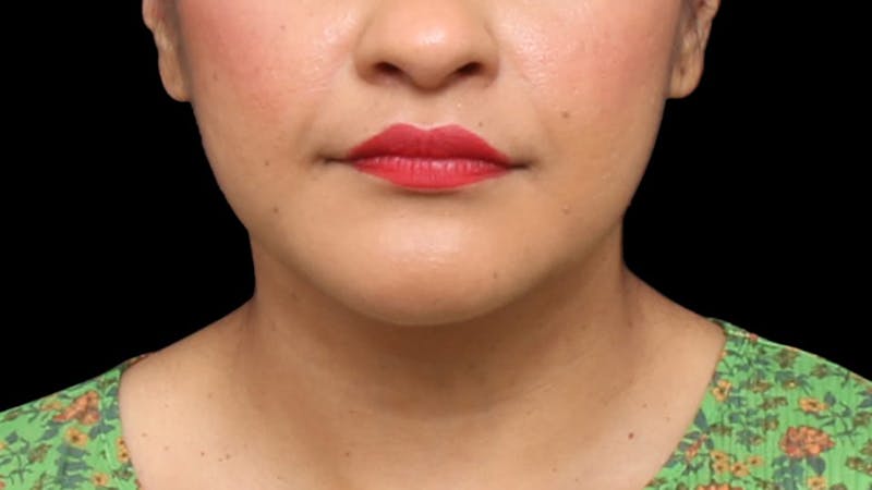 Chin Liposuction Before & After Gallery - Patient 313835 - Image 10
