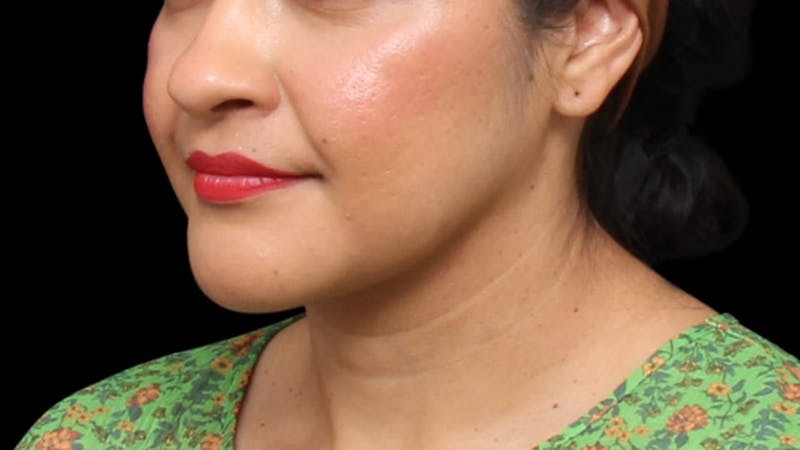 Chin Liposuction Before & After Gallery - Patient 313835 - Image 4