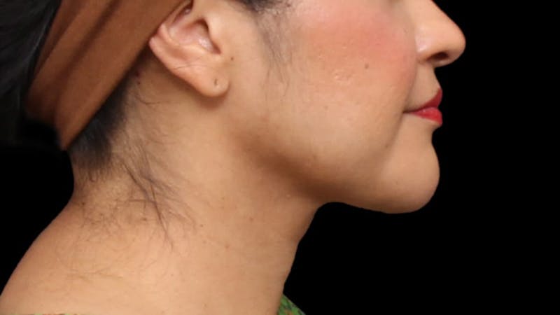 Chin Liposuction Before & After Gallery - Patient 313835 - Image 6