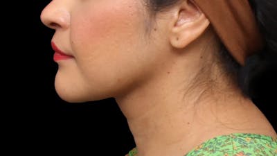 Chin Liposuction Before & After Gallery - Patient 313835 - Image 2