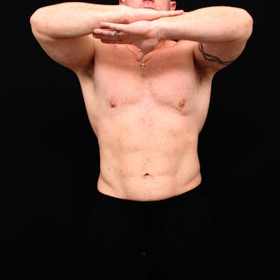Hi Def Lipo Before & After Gallery - Patient 345476 - Image 2