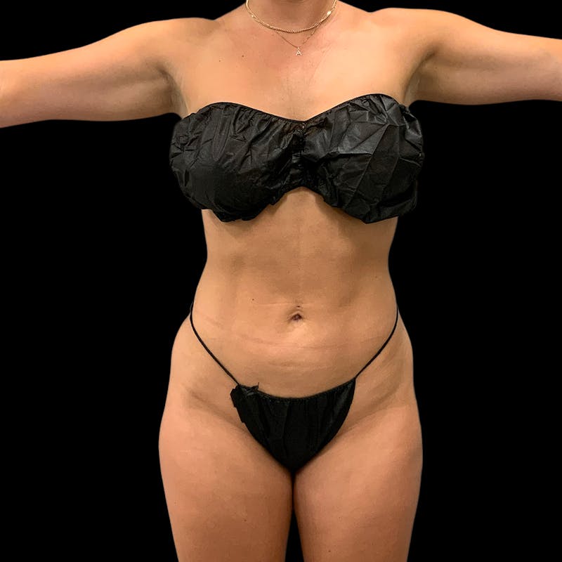 Hi Def Lipo Before & After Gallery - Patient 633553 - Image 2