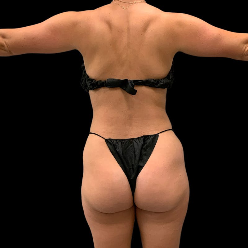 Hi Def Lipo Before & After Gallery - Patient 633553 - Image 8