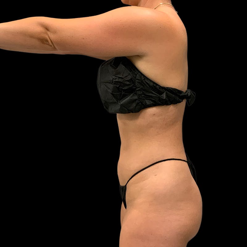 Hi Def Lipo Before & After Gallery - Patient 633553 - Image 12
