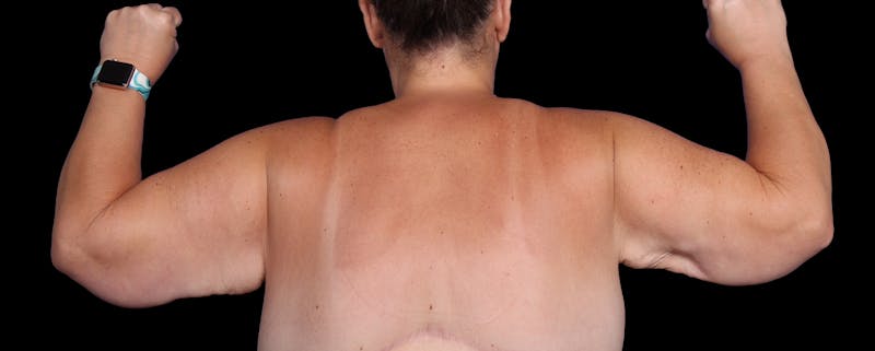 Arm Lift Before & After Gallery - Patient 407722 - Image 3
