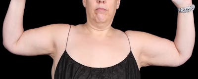 Arm Lift Before & After Gallery - Patient 407722 - Image 2