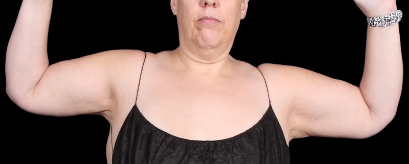 Arm Lift Before & After Gallery - Patient 407722 - Image 2