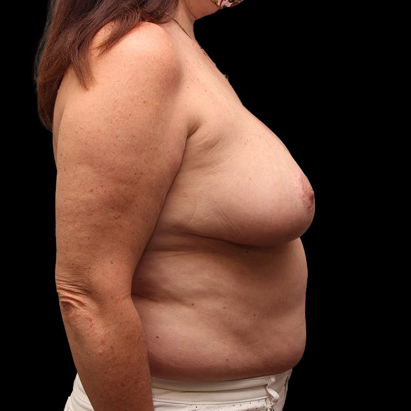 Breast Lift Before & After Gallery - Patient 339072 - Image 6