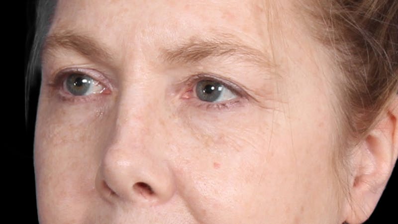 Upper Blepharoplasty Before & After Gallery - Patient 119658 - Image 5