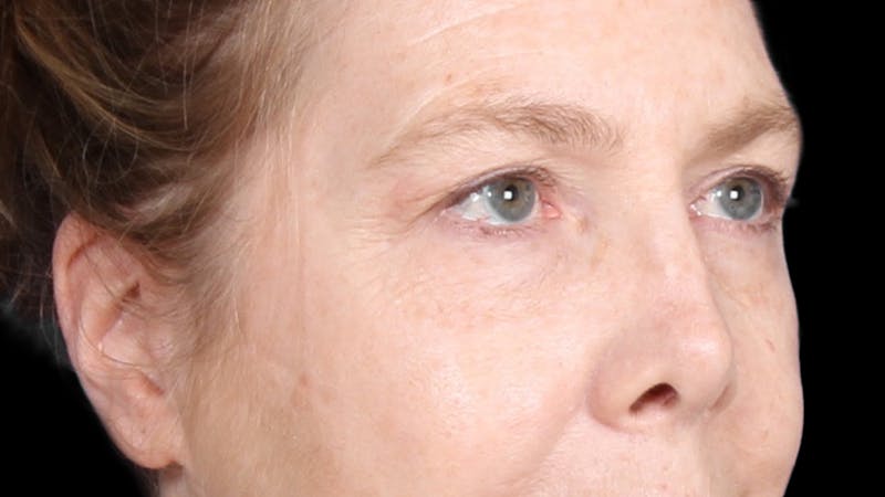 Upper Blepharoplasty Before & After Gallery - Patient 119658 - Image 3