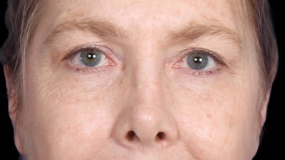 Upper Blepharoplasty Before & After Gallery - Patient 119658 - Image 1