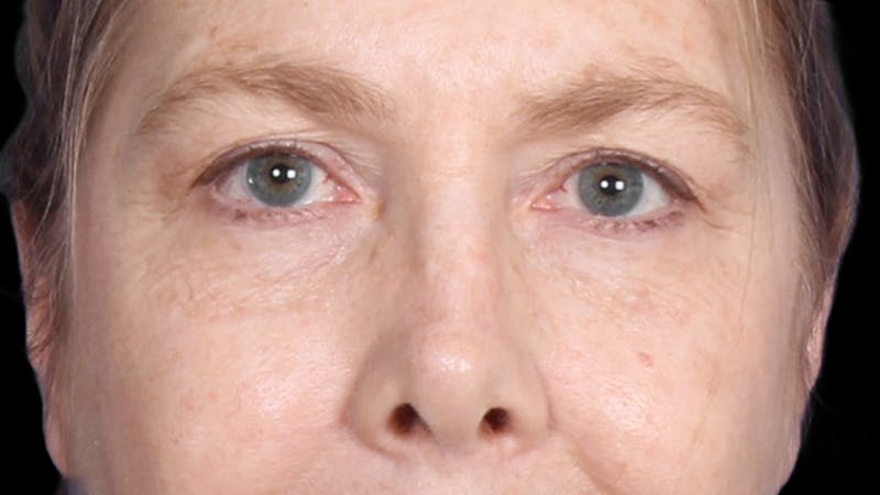 Upper Blepharoplasty Before & After Gallery - Patient 119658 - Image 1