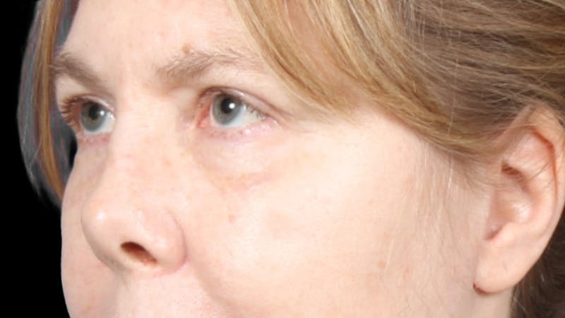 Upper Blepharoplasty Before & After Gallery - Patient 119658 - Image 6