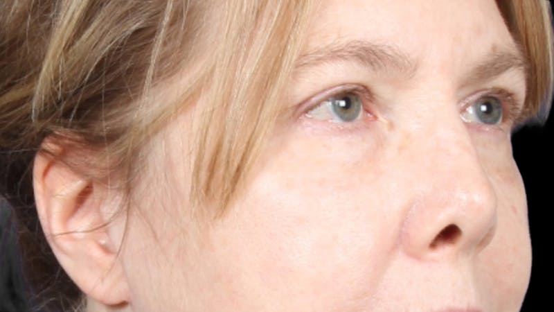 Upper Blepharoplasty Before & After Gallery - Patient 119658 - Image 4