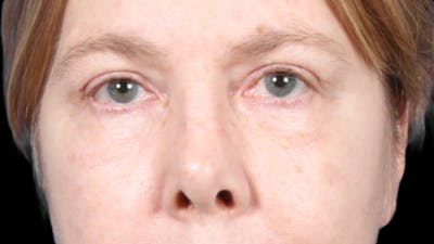 Upper Blepharoplasty Before & After Gallery - Patient 119658 - Image 2