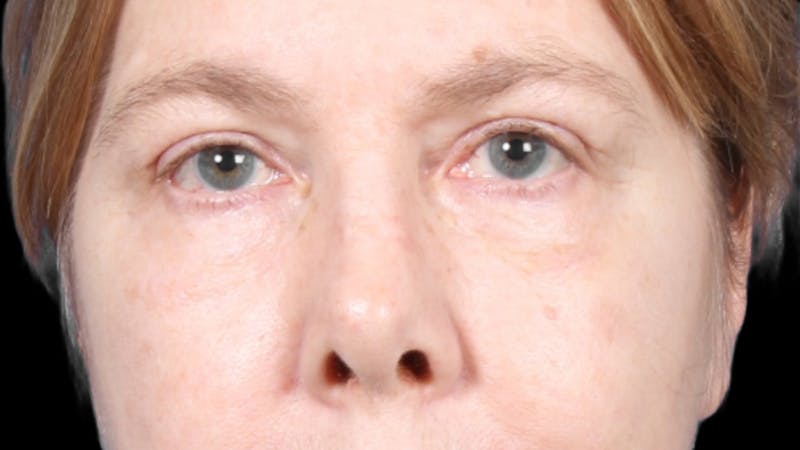 Upper Blepharoplasty Before & After Gallery - Patient 119658 - Image 2