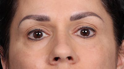 Upper Blepharoplasty Before & After Gallery - Patient 687926 - Image 1
