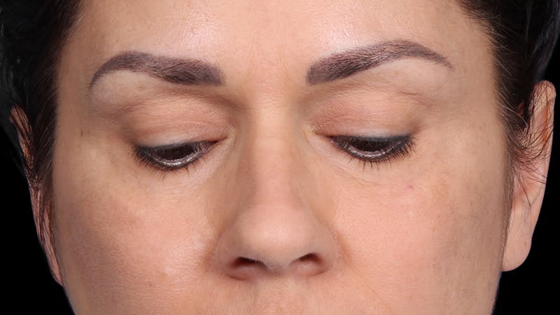 Upper Blepharoplasty Before & After Gallery - Patient 687926 - Image 3