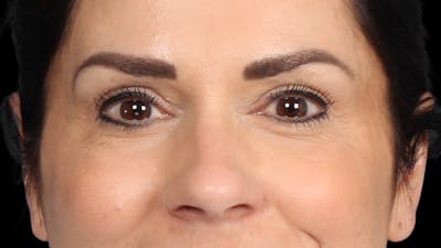 Upper Blepharoplasty Before & After Gallery - Patient 687926 - Image 2