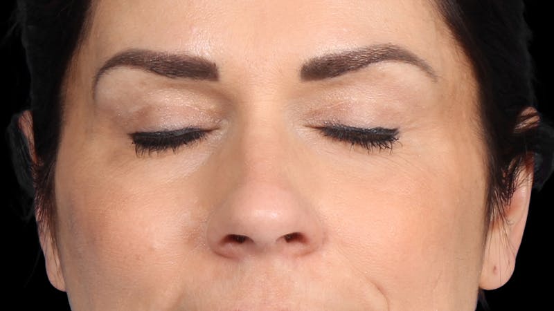 Upper Blepharoplasty Before & After Gallery - Patient 687926 - Image 4