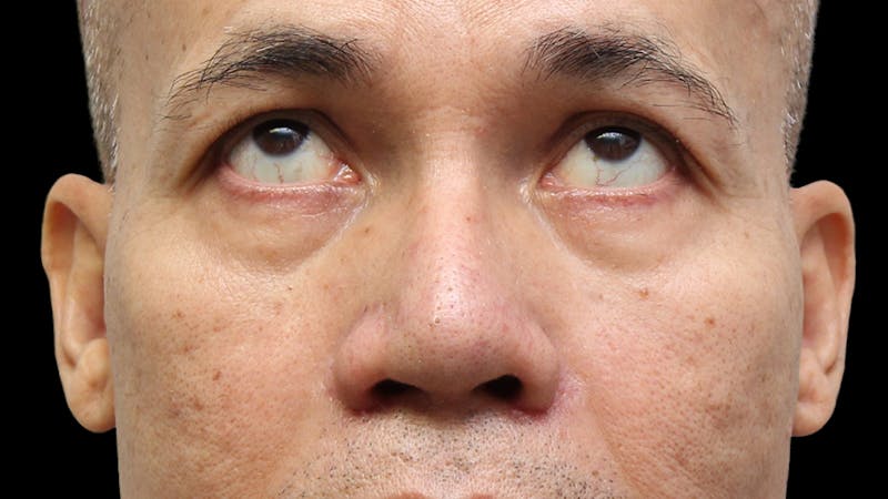 Lower Blepharoplasty Before & After Gallery - Patient 151964 - Image 7