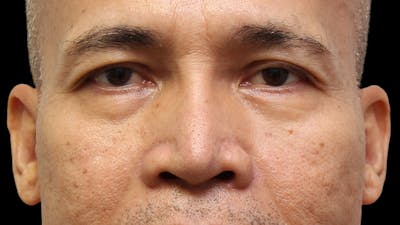 Lower Blepharoplasty Before & After Gallery - Patient 151964 - Image 1