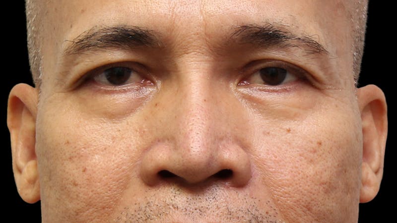 Lower Blepharoplasty Before & After Gallery - Patient 151964 - Image 1