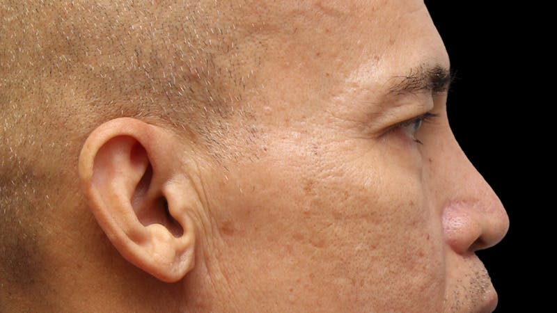 Lower Blepharoplasty Before & After Gallery - Patient 151964 - Image 5