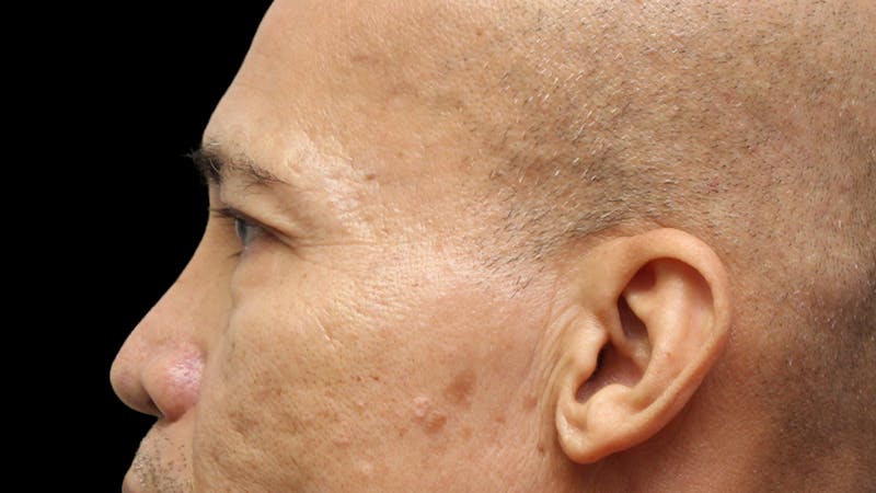 Lower Blepharoplasty Before & After Gallery - Patient 151964 - Image 11