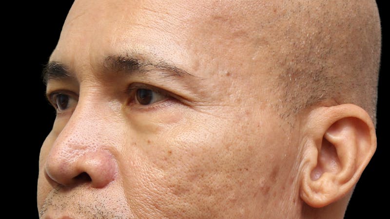 Lower Blepharoplasty Before & After Gallery - Patient 151964 - Image 9