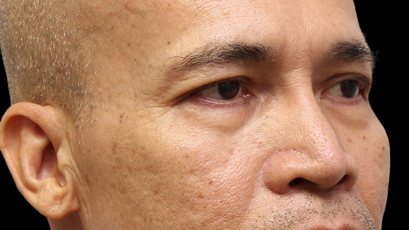 Lower Blepharoplasty Before & After Gallery - Patient 151964 - Image 3