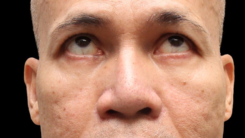 Lower Blepharoplasty Before & After Gallery - Patient 151964 - Image 8