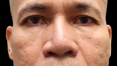 Lower Blepharoplasty Before & After Gallery - Patient 151964 - Image 2