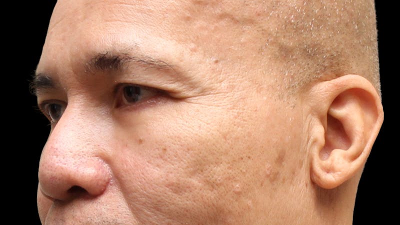 Lower Blepharoplasty Before & After Gallery - Patient 151964 - Image 10