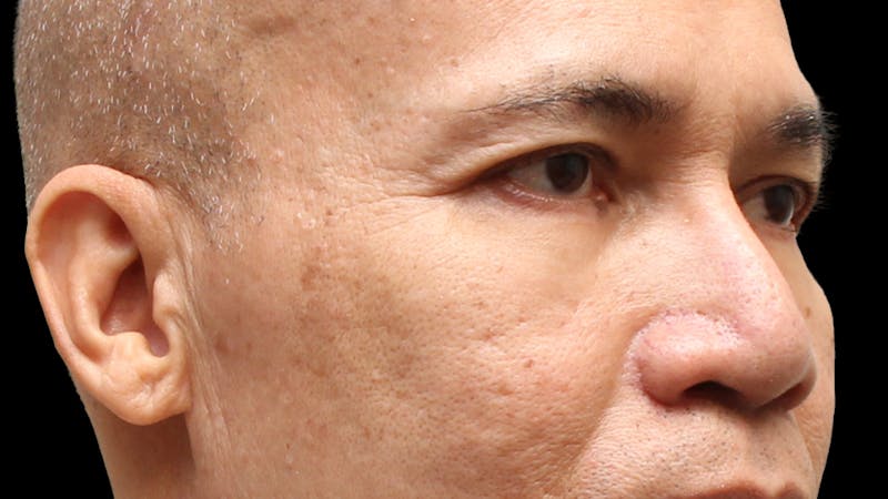 Lower Blepharoplasty Before & After Gallery - Patient 151964 - Image 4