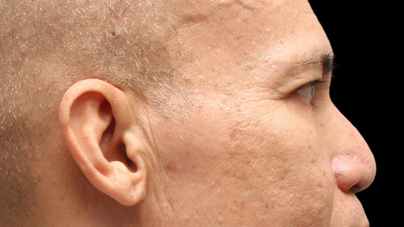 Lower Blepharoplasty Before & After Gallery - Patient 151964 - Image 6