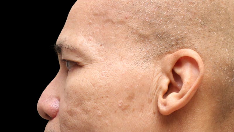 Lower Blepharoplasty Before & After Gallery - Patient 151964 - Image 12