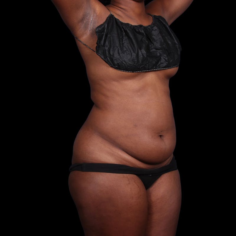 Liposuction Before & After Gallery - Patient 393787 - Image 5