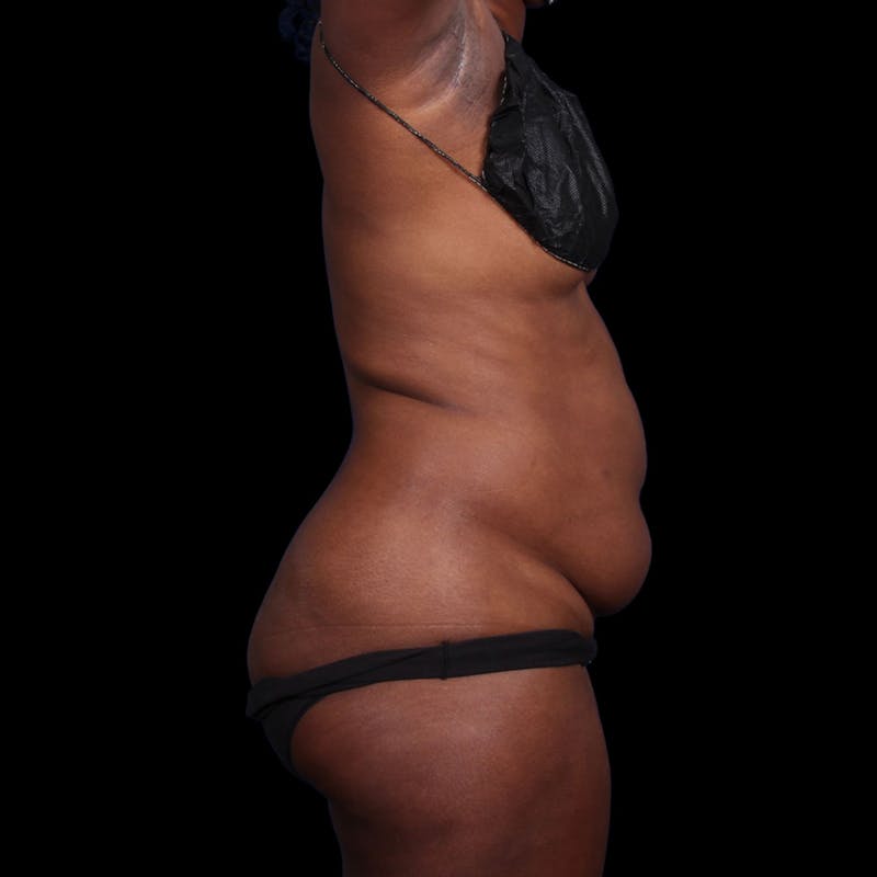 Liposuction Before & After Gallery - Patient 393787 - Image 7