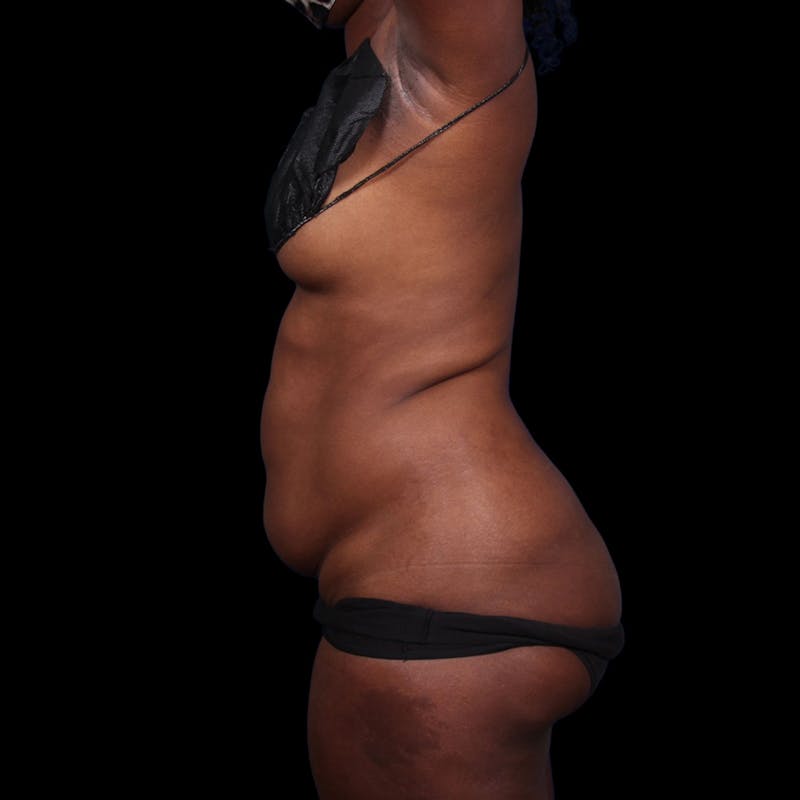 Liposuction Before & After Gallery - Patient 393787 - Image 11