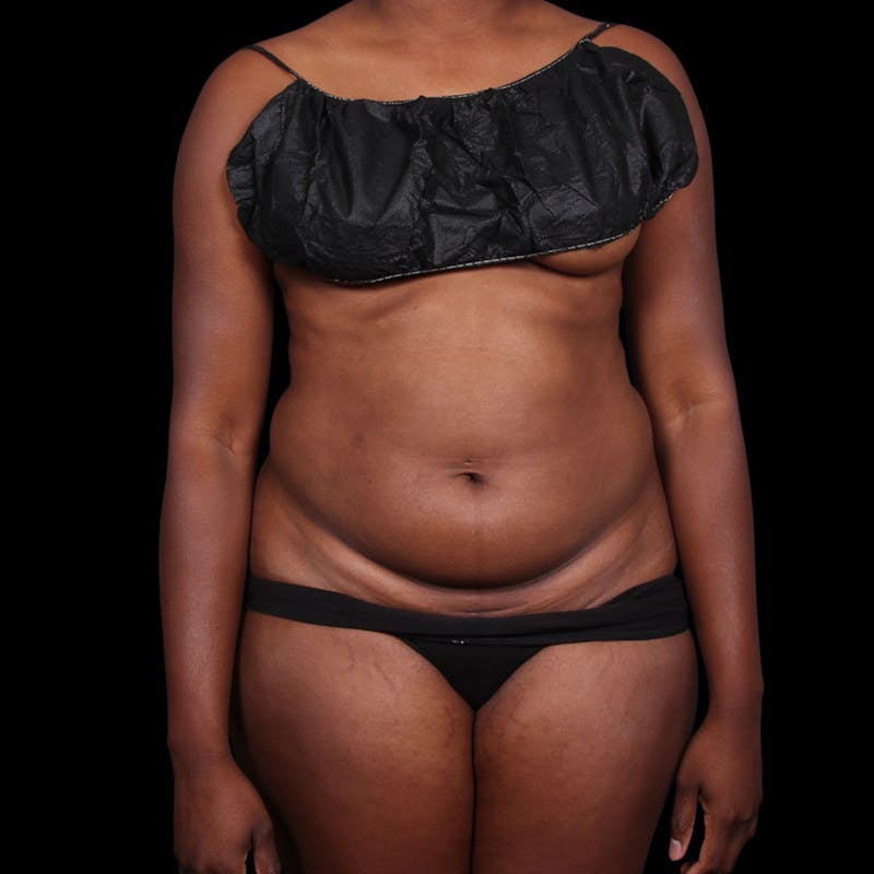 Liposuction Before & After Gallery - Patient 393787 - Image 3