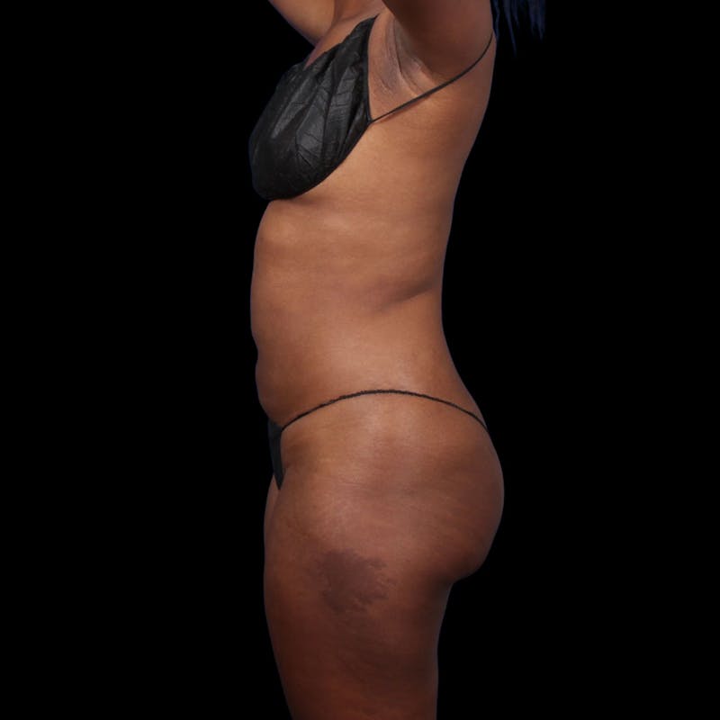 Liposuction Before & After Gallery - Patient 393787 - Image 12