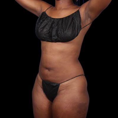 Liposuction Before & After Gallery - Patient 393787 - Image 2