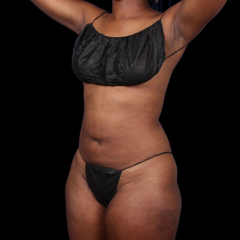 Liposuction Before & After Gallery - Patient 393787 - Image 2
