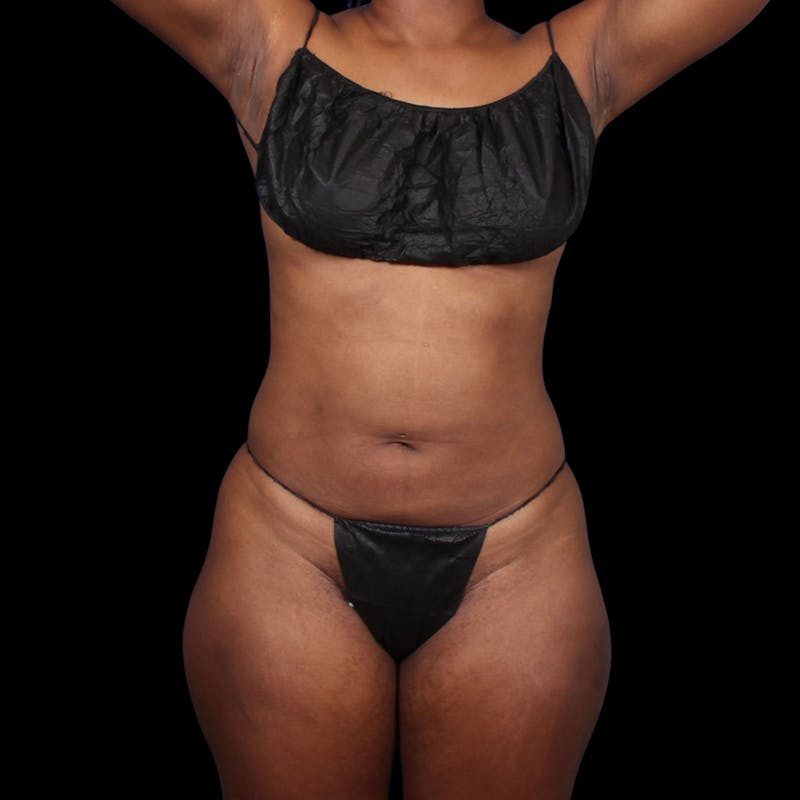 Liposuction Before & After Gallery - Patient 393787 - Image 4
